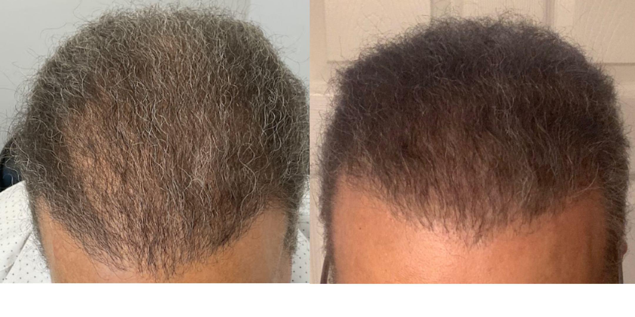 Springs Rejuvenation Before and After